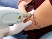 Как вывести татуировку